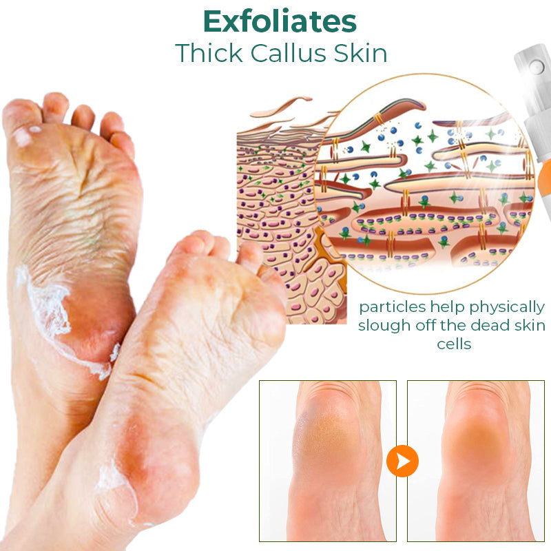 Foot Callus Removal Spray - Foot Peeling Spray, Foot Peeling Spray Oil,  Hydrating Nourish Peel Off Spray, For Quickly Remove Dead Skin And Calluses  On